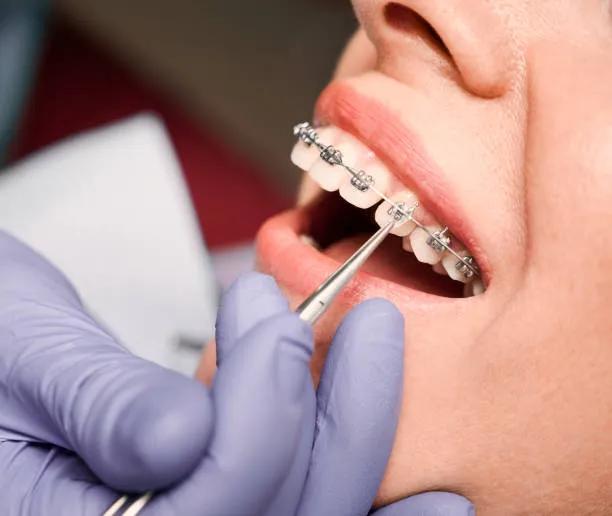 Enhancing Smile Confidence with Advanced Orthodontic Care in Cupertino